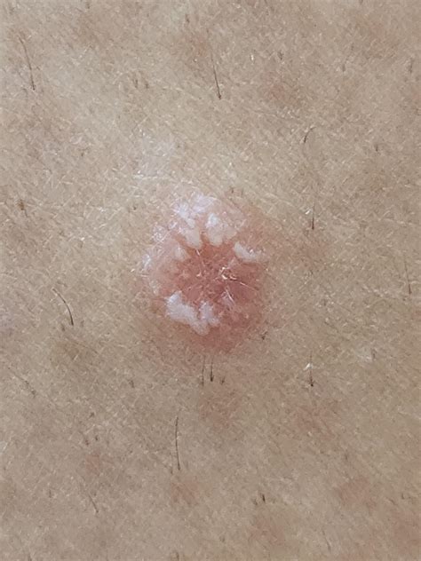 I got this in my skin, it's a bit itchy, and i do see some liquid