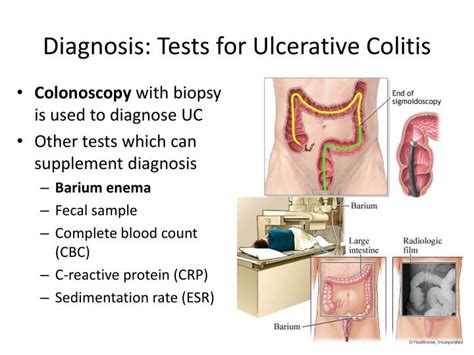 Ppt Ulcerative Colitis Powerpoint Presentation Id