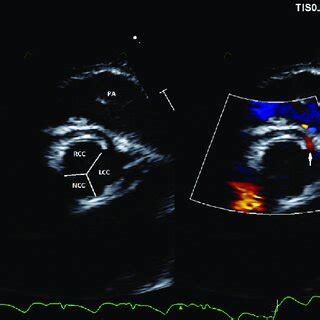 Transthoracic Echocardiogram In The Parasternal Short Axis View With