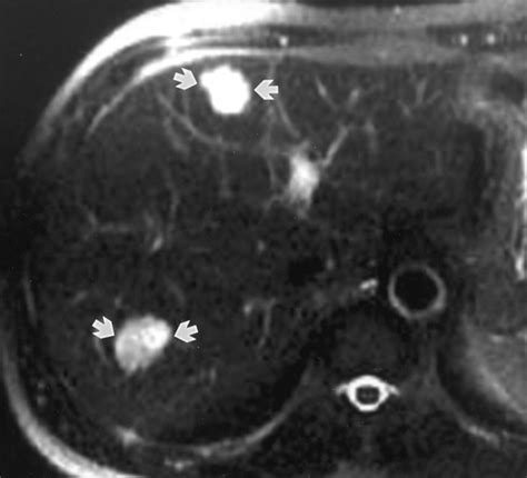 Hepatic Hemangioma Atypical Appearances On Ct Mr Imaging And Sonography Ajr