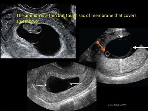 12 Placenta Imaging Dr Ahmed Esawy