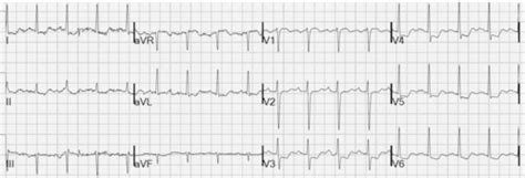 Nstemi Flashcards Quizlet