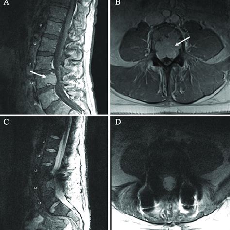 Preoperative Sagittal A And Axial B T1 Weighted Gadoliniumenhanced