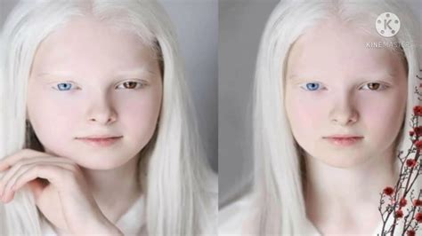 Amina Ependieva Stunning Beauty Of A Girl With Albinism And Heterochromia Youtube