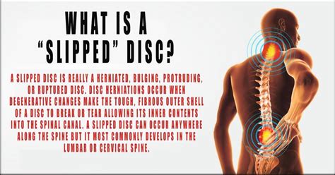 Slipped Discs Understanding Symptoms Risks Treatments