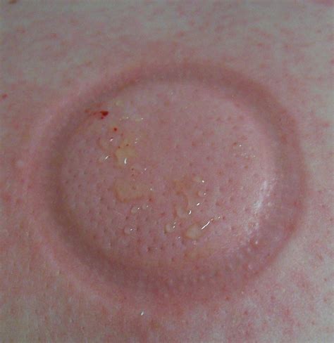 All about medical: Cupping and its benefits