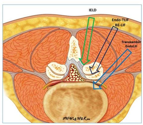 Brain Sciences Free Full Text Uniportal Full Endoscopic