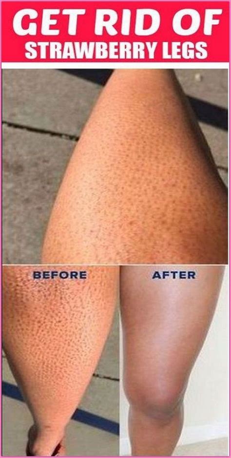 How To Get Rid Of Strawberry Legs Artofit