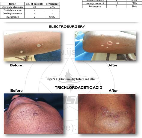 Figure 1 From Comparative Efficacy Of Electrosurgery With Topical 50