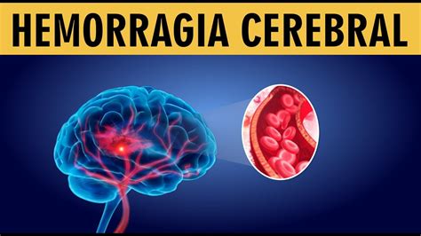 Hemorragia Cerebral O Que Você Precisa Saber Sintomas Causas E