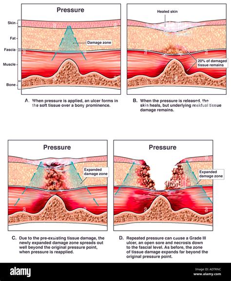 How Do Pressure Ulcers Happen at Christina Vargas blog