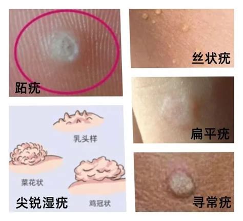 hpvhpv
