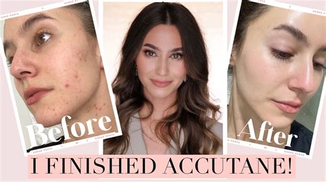 I Finished Accutane Results Side Effects Low Dose Isotretinoin