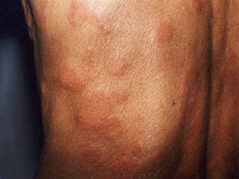 Leprosy Hansen S Disease Cause Mycobacterium Leprae