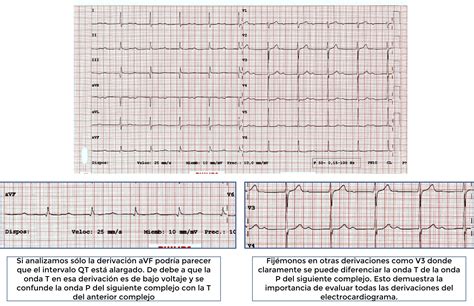 Paciente De A Os Con Electrocardiograma Raro