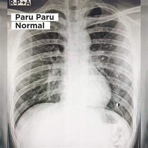 gambaran paru paru normal tidak  bercakan penyakit