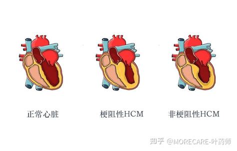 新证据指南支持玛伐凯泰 Mavacamten用于肥厚型心肌病 知乎