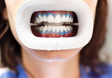 How To Whiten Sensitive Teeth Ultimate Guide