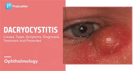 Dacryocystitis Causes Types Symptoms Diagnosis