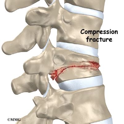 Vertebroplasty | eOrthopod.com