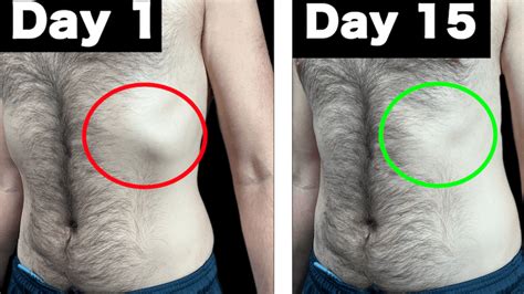 how to fix a rib out of place