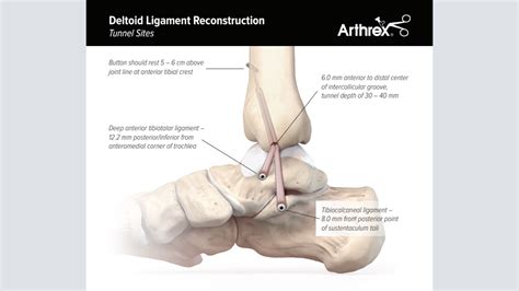 Arthrex Deltoid Ligament Reconstruction