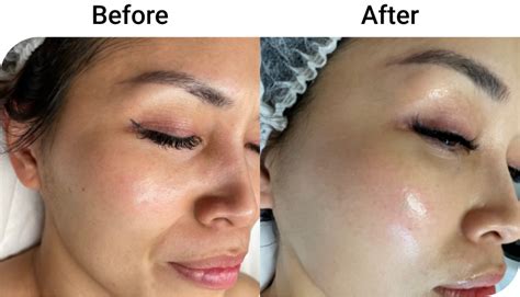 Gardenia Skin Co.'s Pico Laser Before & After