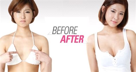 Breast Augmentation Mommy Makeover Singapore