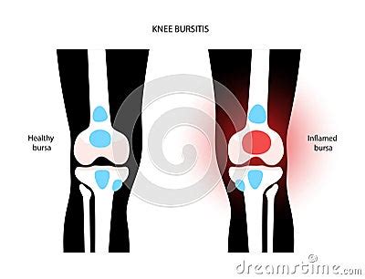 Bursitis Inflammation Concept Cartoon Vector Cartoondealer