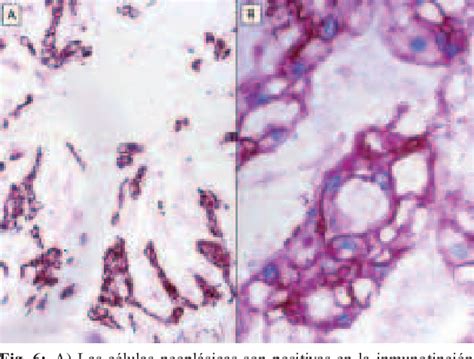 Figure 4 from Cordoma Sus variantes y diagnóstico diferencial Chordoma