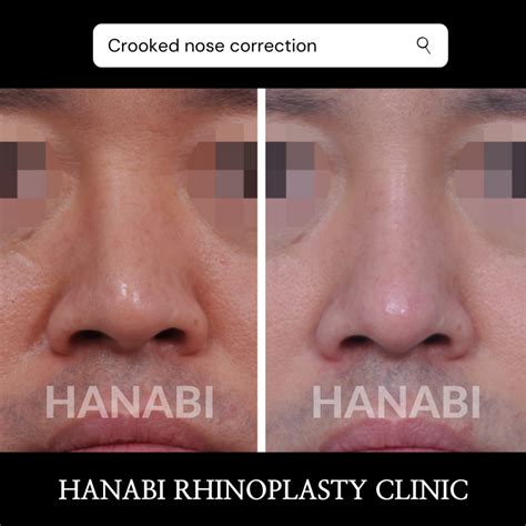 Nostrils Asymmetry Revision After Rhinoplasty – HANABI RHINOPLASTY CLINIC