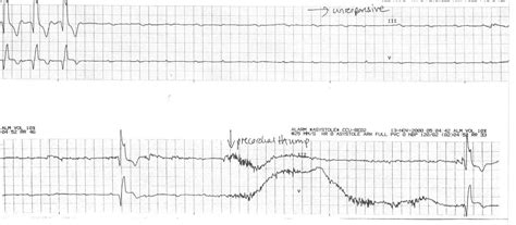 50225-Precordial-thump - Acilci.Net