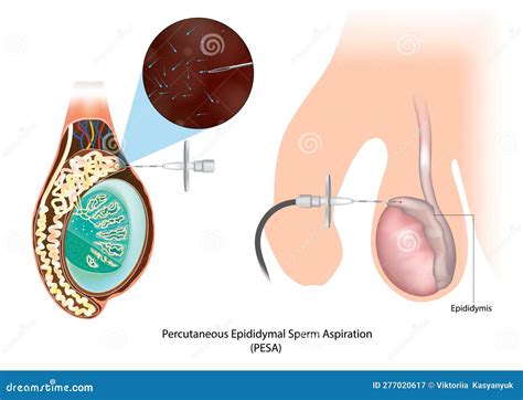 Percutaneous Epididymal Sperm Aspiration Pesa Testicular Biopsy