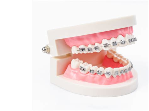 Metal Dental Braces Victor Smiles Victor Ny