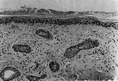 Immunohistochemical Nuclear Staining For P Pcna And Ki In