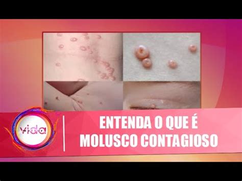 Saiba o que é molusco contagioso e como tratar 04 12 20 YouTube