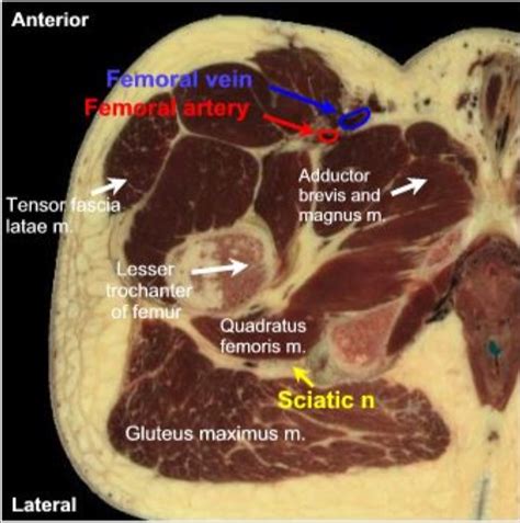 Sciatic Nerve Block Anterior Approach