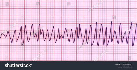 Torsades De Pointes Rhythm Strip