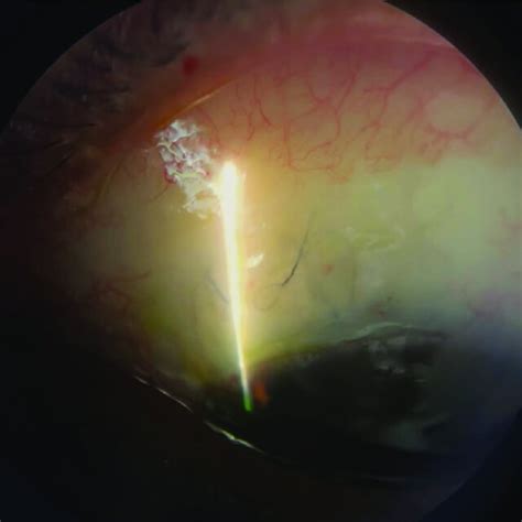 Lowly Elevated Filtering Trabeculectomy Bleb With Releasable Sutures