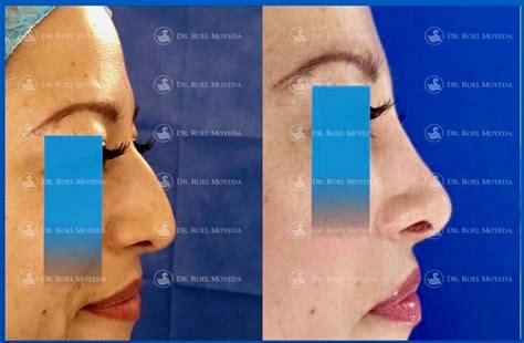 Rinoplastia Caso 85 Rinoplastia Reductora Mas D Ti Facial