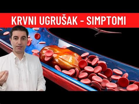 Imate KRVNI UGRUŠAK Ovako ćete znati YouTube