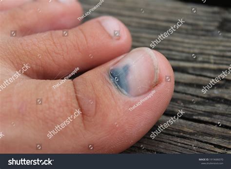 Subungual Hematoma Present Under Toenail Hallux Foto Stok 1919686070