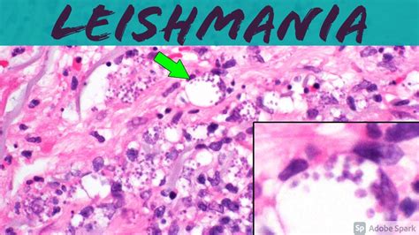 Leishmaniasis Leishmania Infection 5 Minute Pathology Pearls