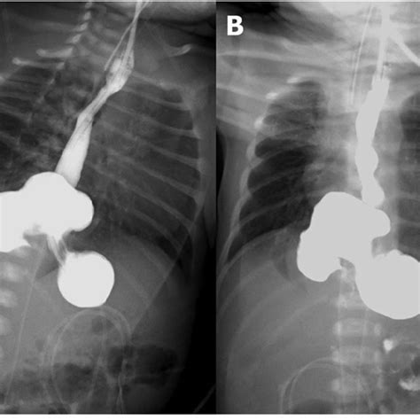 Hiatal Hernia Pediatric Radiology Hunter Goldsmith