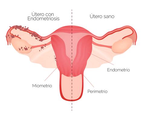 Endometriosis