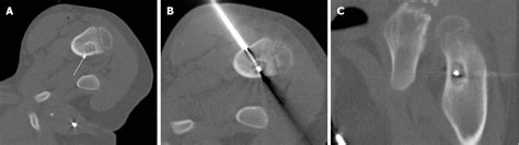 Figure From Ct Guided Radiofrequency Ablation Of Osteoid Osteoma In