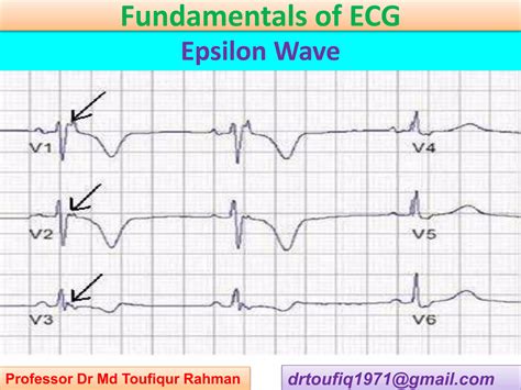 Epsilon Wave In Ecg Ppsx