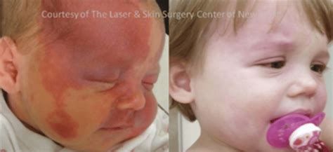 Laser And Skin Surgery Center Of New York Port Wine Birthmark Laser