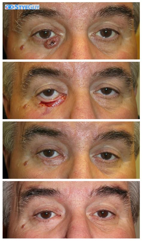 Basal Cell Carcinoma Reconstruction Styeguy Consult Online Today