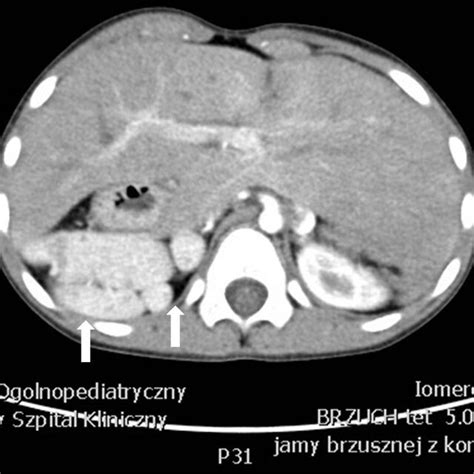 The Giant Accessory Spleen Ultrasound Scan Of The Splenic Area With